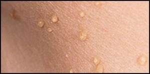 A close up of the skin with many drops on it
