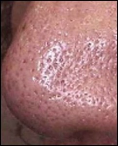 A close up of the skin on a person 's nose.