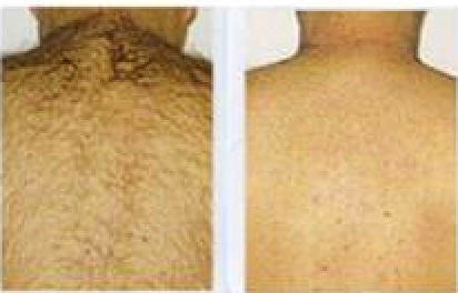 A before and after picture of the back of someone 's body.