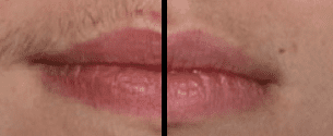 A before and after picture of the lips