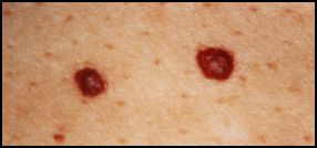 A close up of two spots on the skin