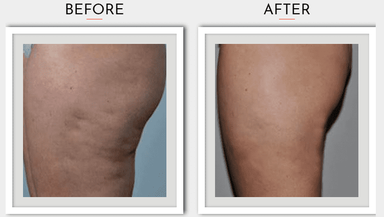 Lumicell Cellulite and Body Contouring, Toronto