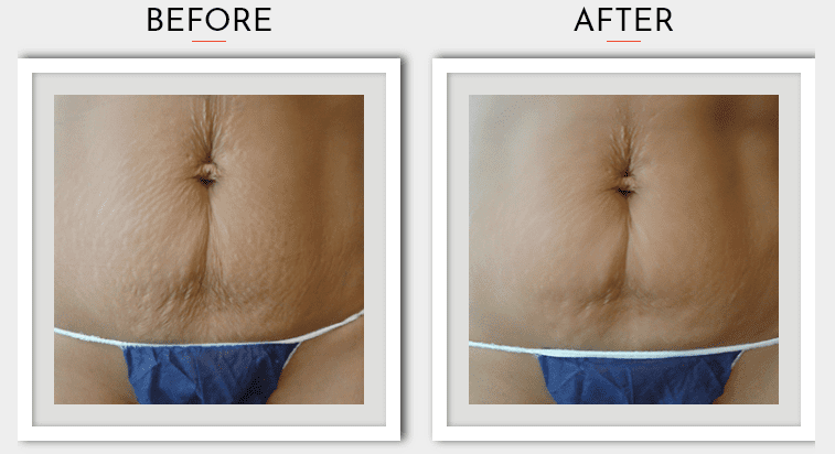 A before and after picture of the stomach showing a stretch mark.